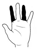 ひとさし指を含めて一上肢の二指2