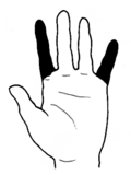 ひとさし指を含めて一上肢の二指3
