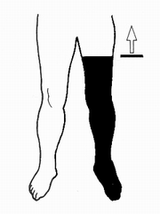 一下肢を大腿の2分の1以上で欠く